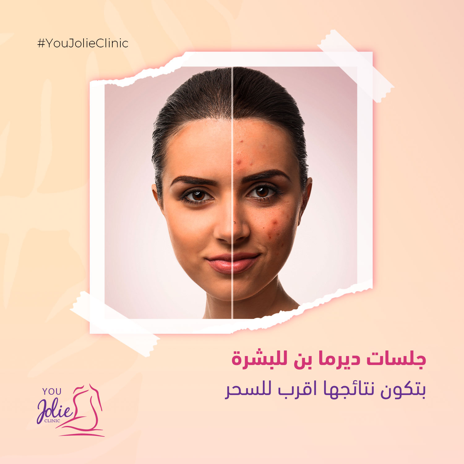 You Jolie Clinic Service Marketing Campaign Social Media Content Copywriting SkinCare Beauty Clinic